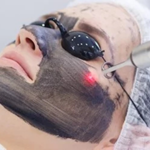 Carbon Laser Treatment